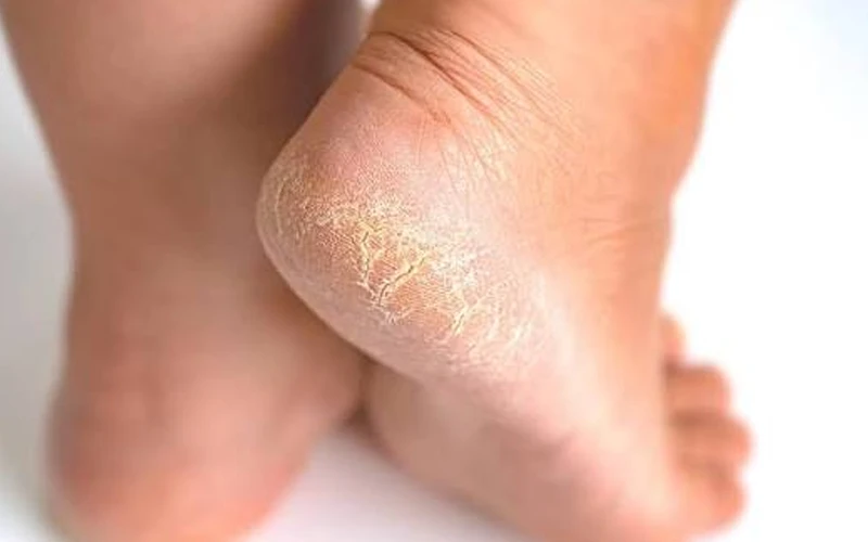 عکس ترک پا